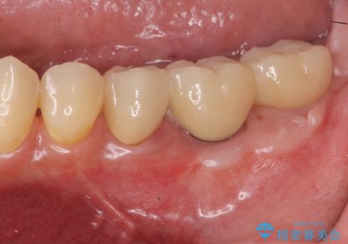 遊離歯肉移植術を併用した、破折歯のインプラント治療の症例 治療後