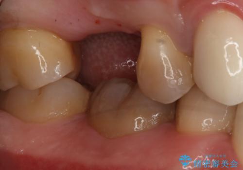 歯を入れたい インプラント+セラミッククラウンの治療前