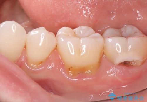 【セラミッククラウン】【生活歯髄療法】歯に穴が空いているの症例 治療前