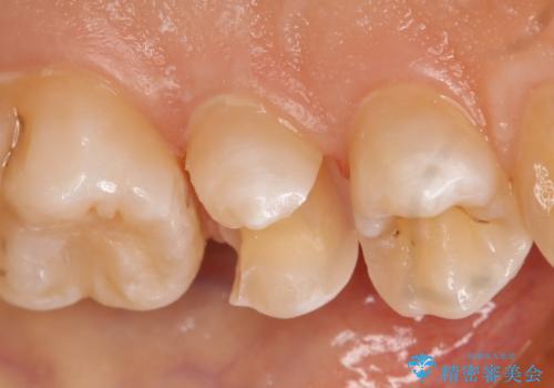 虫歯を治療したい　セラミックインレーの治療中