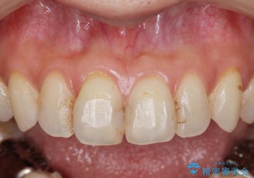 前歯の劣化したコンポジットレジン修復をセラミッククラウンへの治療前