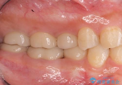 { 歯周外科 }  骨隆起除去を含む歯冠長延長術の治療後