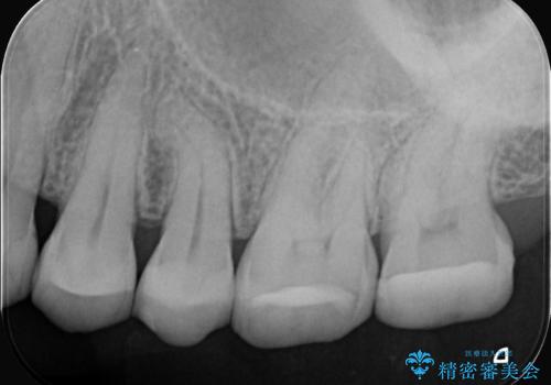 奥歯の痛みを根本から解消し、クラウンで歯の強度を回復の治療前