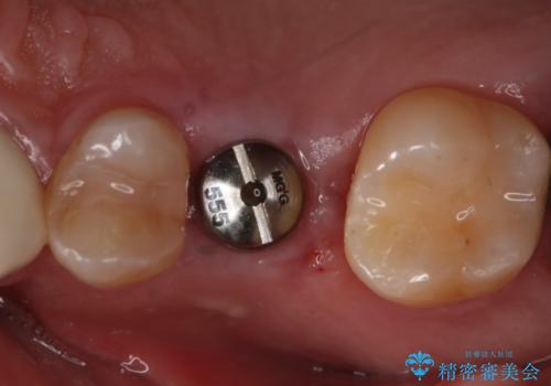 歯を入れたい　インプラント+セラミッククラウンの治療中