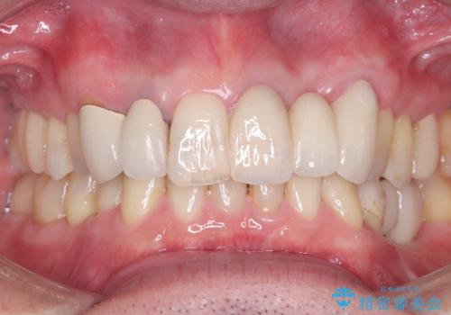 【セラミッククラウン】【エクストリュージョン】抜歯はしたくないの治療後