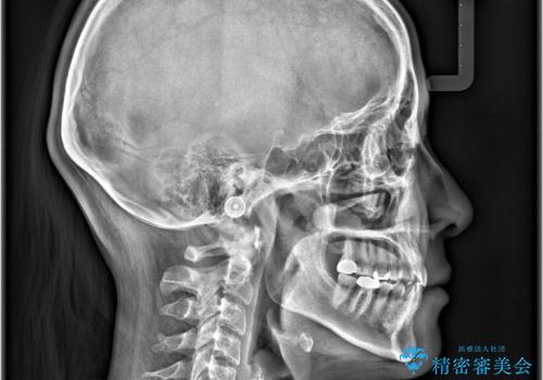 すきっ歯・切端咬合・空隙歯列|インビザラインで11ヵ月で治療完了の治療後