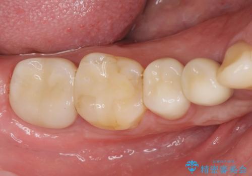 すべての虫歯治療をしたいの治療後