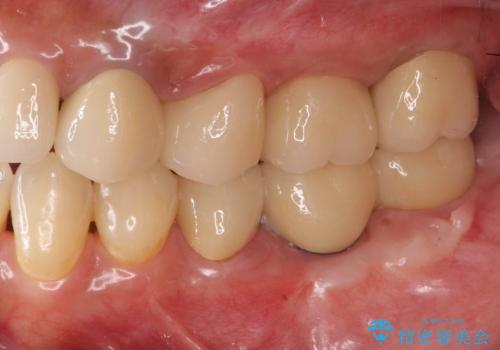 遊離歯肉移植術を併用した、破折歯のインプラント治療の治療後