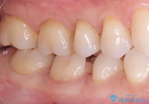【セラミックインレー】歯がたまーにしみるの治療中
