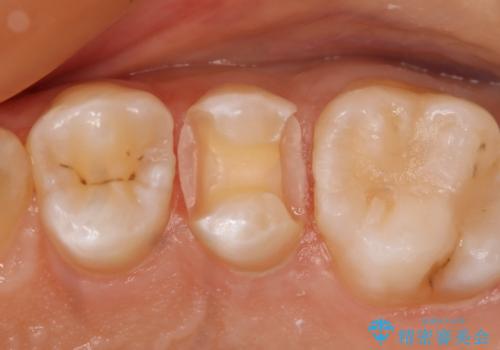 虫歯を治療したい　セラミックインレーの治療中