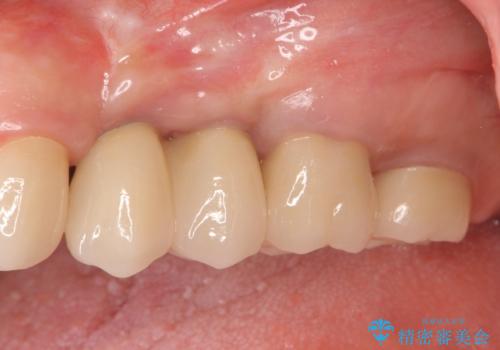 銀歯を外してのインプラント・セラミック治療の症例 治療後