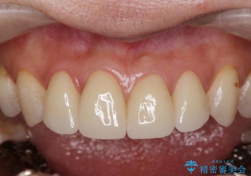 前歯の劣化したコンポジットレジン修復をセラミッククラウンへの治療後
