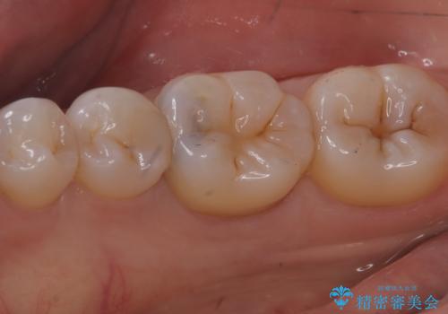 【セラミックインレー】歯がたまーにしみるの治療前