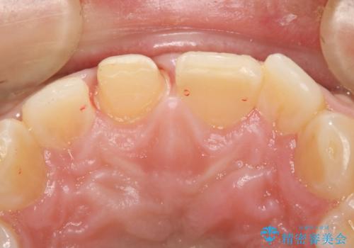 前歯が欠けたので綺麗にしたい オールセラミッククラウンの治療中