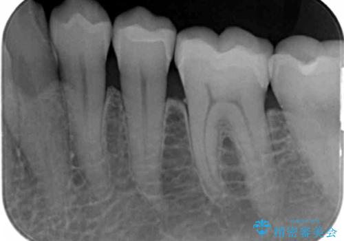 銀歯を外してのセラミック治療の治療後
