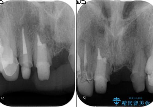 [ セラミック治療 ]  歯ぐきの際の黒ずみを改善したいの治療中
