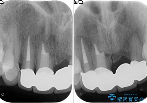 [ セラミック治療 ]  歯ぐきの際の黒ずみを改善したいの治療後