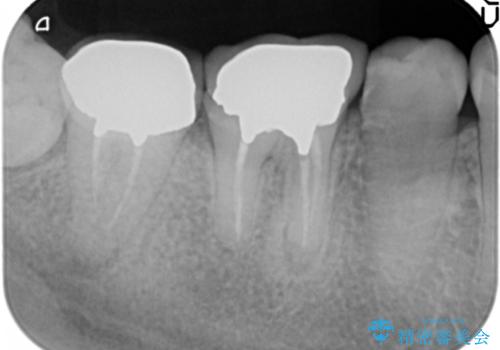 { 歯周外科 }  骨隆起除去を含む歯冠長延長術の治療前