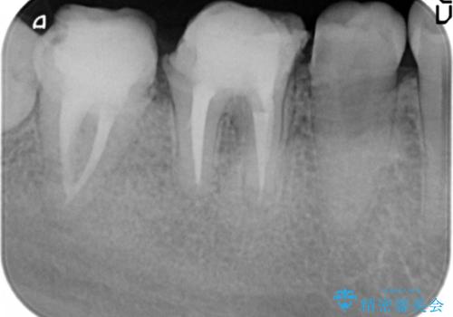 { 歯周外科 } 骨隆起除去を含む歯冠長延長術の治療中