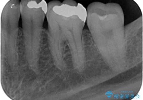 銀歯を外してのセラミック治療の治療前
