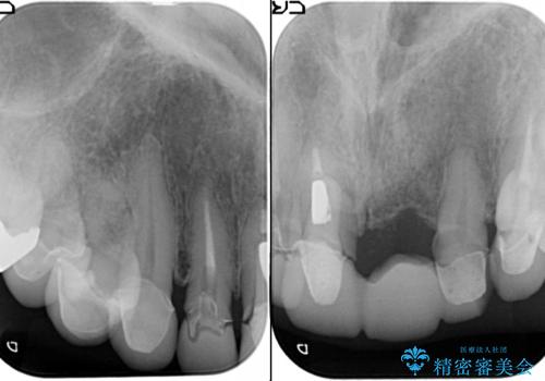[ セラミック治療 ]  歯ぐきの際の黒ずみを改善したいの治療前
