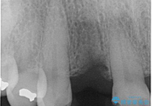 新幹線&飛行機で通院　最小限の通院で前歯のインプラント治療の治療前