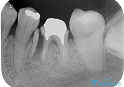 割れてしまった奥歯　1DAYインプラント治療の治療前