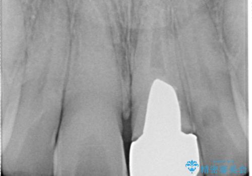 色のバランスの悪い前歯　オールセラミッククラウンで自然な口元にの治療前