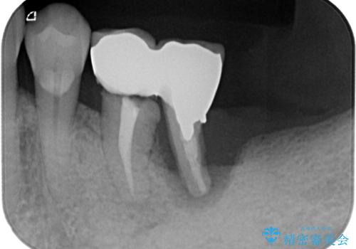 割れて揺れている奥歯　抜歯即時・早期埋入インプラント治療の治療前