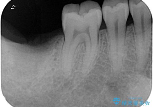 抜歯になった奥歯 速やかな埋入による短期間インプラント治療の治療前