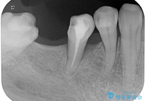 抜歯とむし歯治療を途中で放置 インプラント補綴治療の治療前