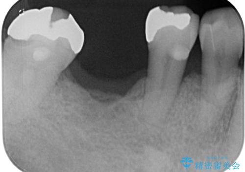 抜歯して放置したままの奥歯　即時荷重インプラントの治療前