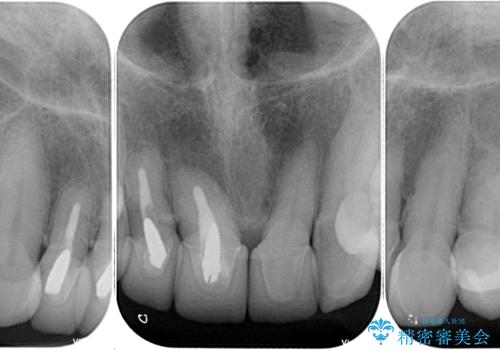 不釣り合いで境目の露出した前歯　オールセラミッククラウンによる審美歯科治療の治療前