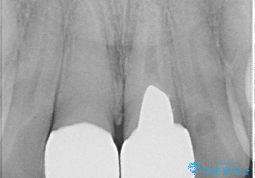 色のバランスの悪い前歯　オールセラミッククラウンで自然な口元にの治療後