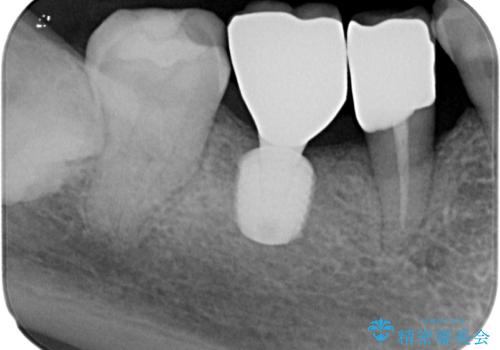 抜歯とむし歯治療を途中で放置 インプラント補綴治療の治療後
