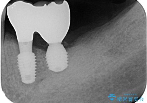 割れて揺れている奥歯　抜歯即時・早期埋入インプラント治療の治療後