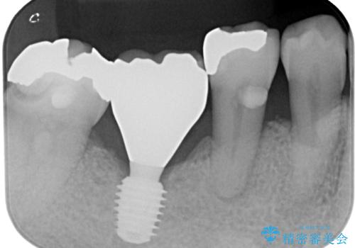 抜歯して放置したままの奥歯 即時荷重インプラントの治療後