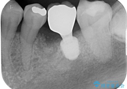 割れてしまった奥歯　1DAYインプラント治療の治療後