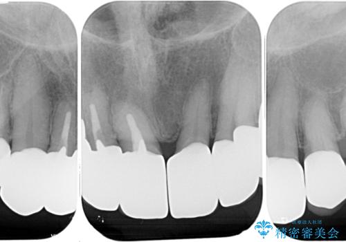 不釣り合いで境目の露出した前歯 オールセラミッククラウンによる審美歯科治療の治療後