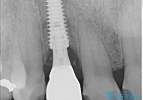 新幹線&飛行機で通院 最小限の通院で前歯のインプラント治療の治療後