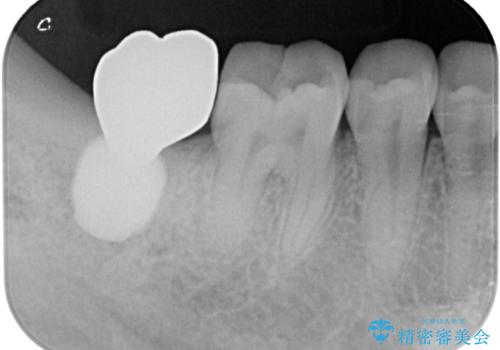 抜歯になった奥歯　速やかな埋入による短期間インプラント治療の治療後