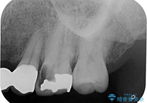 奥歯がしみる オールセラミッククラウンによる奥歯のむし歯治療の治療前