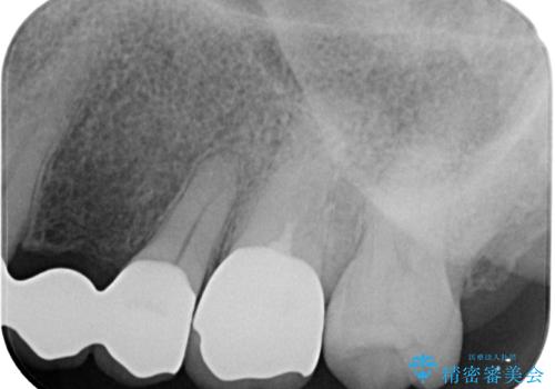 奥歯がしみる オールセラミッククラウンによる奥歯のむし歯治療の治療後