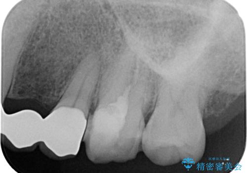 奥歯がしみる　オールセラミッククラウンによる奥歯のむし歯治療の治療中