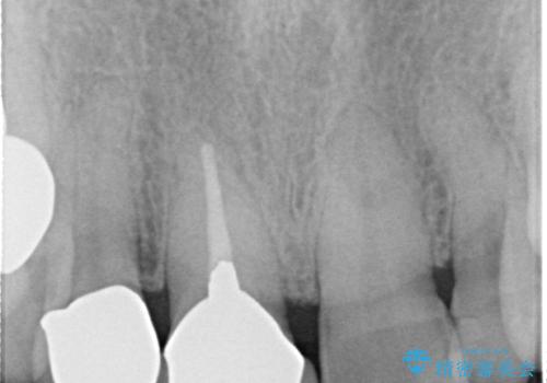 しみる前歯のセラミック治療　周辺も同時に治療して調和の取れた前歯にの治療前