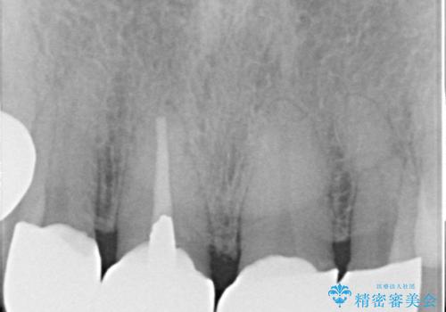 しみる前歯のセラミック治療 周辺も同時に治療して調和の取れた前歯にの治療後