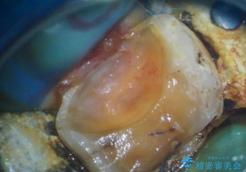 奥歯がしみる オールセラミッククラウンによる奥歯のむし歯治療の治療前