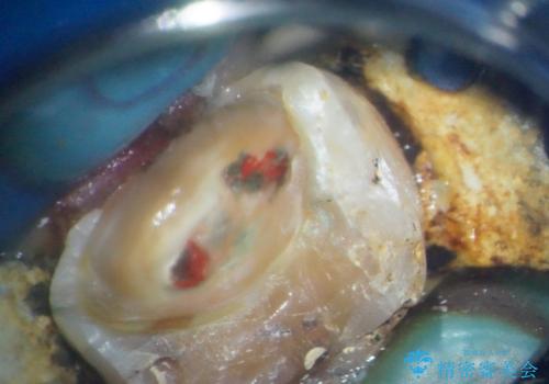 奥歯がしみる オールセラミッククラウンによる奥歯のむし歯治療の治療中