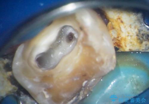 奥歯がしみる オールセラミッククラウンによる奥歯のむし歯治療の治療前