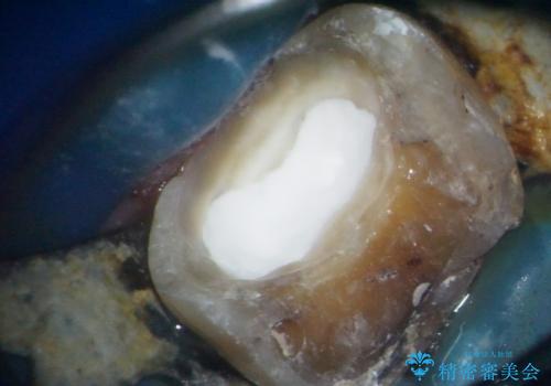 奥歯がしみる オールセラミッククラウンによる奥歯のむし歯治療の治療中